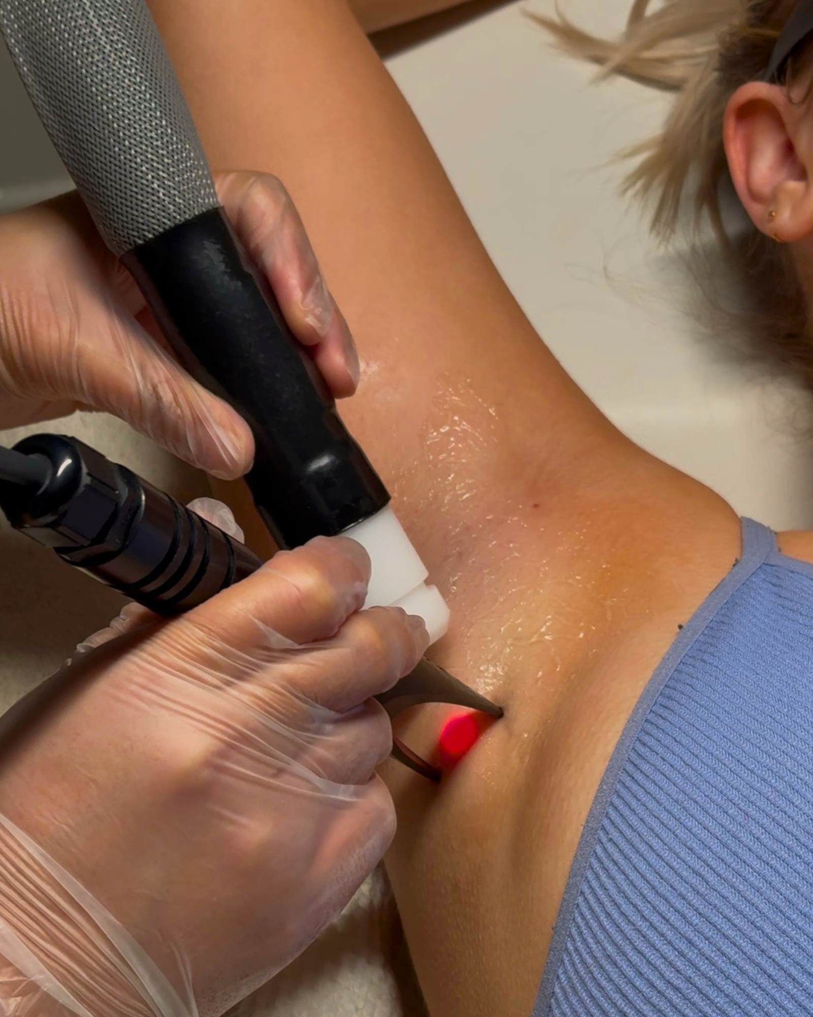 Laser hair removal treatment at Laser & Spa UK in Cheshire