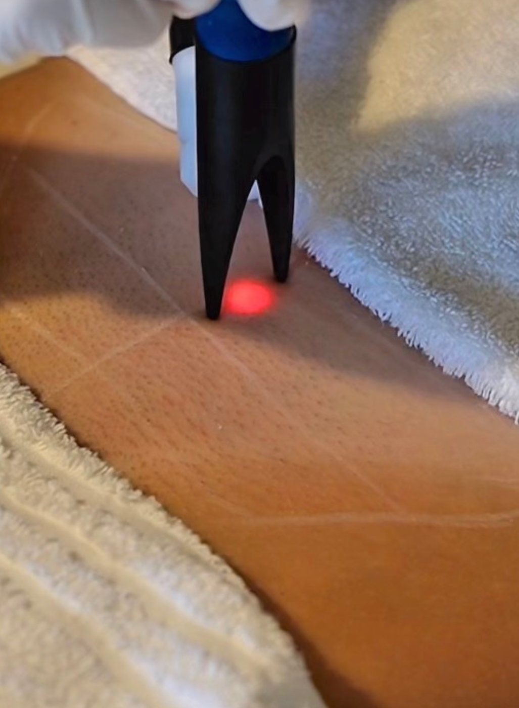 Laser hair removal treatment at Laser & Spa UK in Handforth, Cheshire